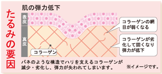 たるみの原因